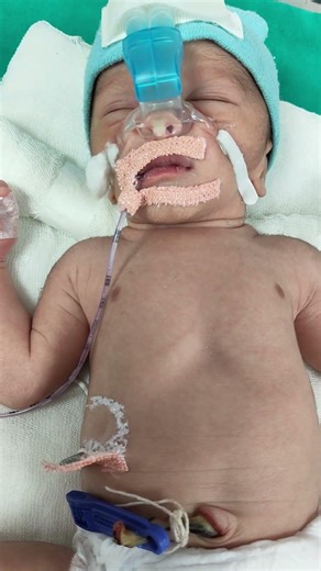 What is CPAP Support for Newborns? 🏥👶 #nicu #babycare #health #doctor