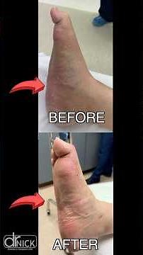 Fixing Charcot Foot With Arthrex External Fixation