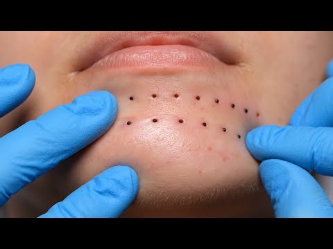 Chin Blackhead Extraction Professional Popping and Cleaning