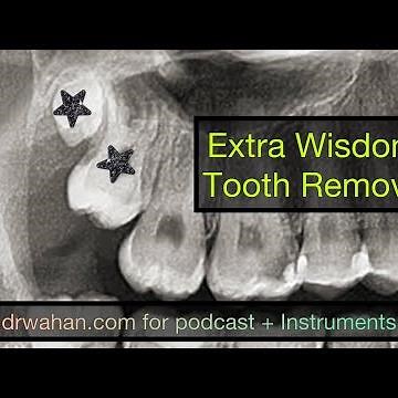 Black + White Version: Extra Upper Wisdom Tooth Extraction with Instruments Used