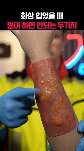 화상 입었을 때 절대 하면 안 되는 행동들!