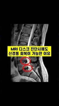 Why You Can Recover Even With a Herniated Disc on MRI