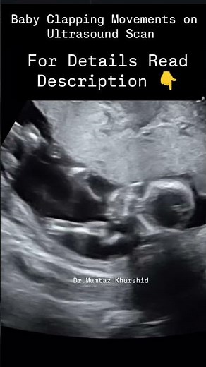 Baby Clapping Movements Seen on Ultrasound Scan In Pregnancy
