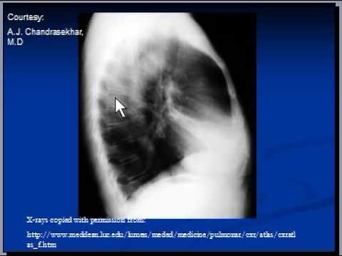 Chest x-ray interpretation --Right middle lobe collapse