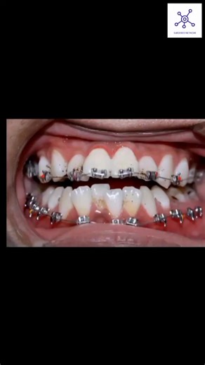 Celebrating My Braces Removal Journey