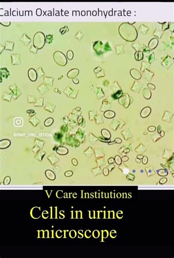 Cells in urine slide | urine slide | urine microscopy
