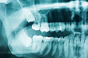 Wisdom Teeth Removal in Hong Kong | Cost & Insurance | Alea