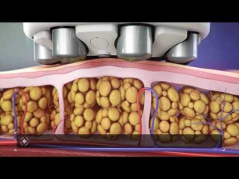 Venus Legacy™: An Advanced Solution for Challenging Aesthetics