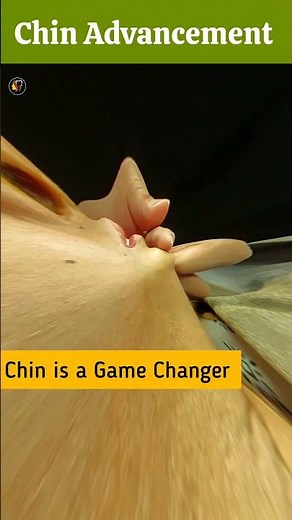 Chin Advancement | Sliding Genioplasty at Aldaim Dental Center