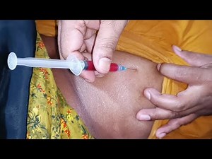 Must Watch Vitamin B1,B6,B12 Buttock Injection Video Ep _39 Injection Vision