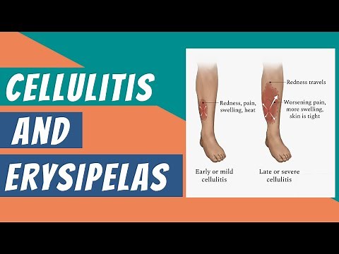 What are Cellulitis And Erysipelas? | it's Clinical features - Diagnosis & Treatment | Dermatology