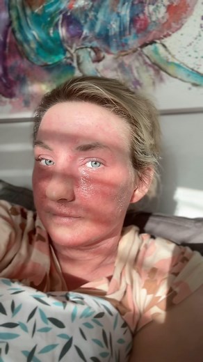 Amy Wilson on Instagram: "The music - IYKFK. First day at home after being discharged yesterday evening. My skin is ‘sparkling’ today. It’s sore, itchy, red and oozing. Only applied moisturiser once today, after my shower and only showered because my skin felt horrible. There’s pain all over my skin. Dermatologist prescribed Aciclovir for the viral infection on my skin. The swelling does seem to be improving though. Dermatology appointment tomorrow afternoon. I’m praying this is for the loading