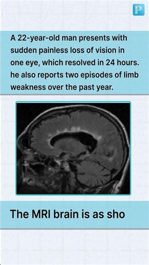 Multiple Sclerosis Clinical Clue You Can’t Miss | FMGE NEET PG