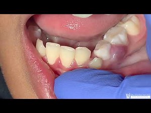 Severe Gum Abscess In A 10 Year Old