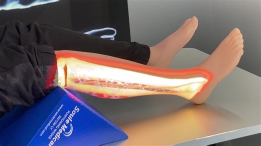 Example of how artificial intelligence (AI) can be used to automatically register medical imaging with actual patient anatomy projected onto the patient's skin. This can be used for surgical planning and marking the patient prior to or during a procedure. This example shows the bone, major blood vessels and small vessels in the lower leg reconstructed from a patient CT scan. The projected image triagulates the position of the patient as they move and recalculates to recenter the image based on a