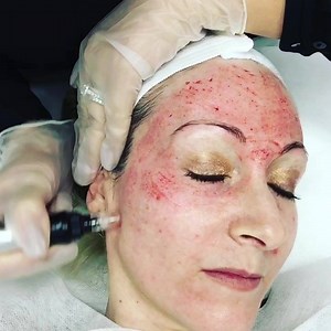 Our exclusive, REGEN PEN treatment, to stimulate the skins natural release of collagen and elastin. Fantastic for minimising large open pores and plumping the skin for a more youthful and glowing complexion. 💆🏼💫👌🏼 Available at all our clinic locations. Enquire today (02)83237510 #youbysia #youthfulskin #skinrejuvenation #skinregeneration #collagenstimulation #cit #skin #healthyskin #glowingskin #minimisepores #skinneedling #antiaging #beautifulskin | You By Sia