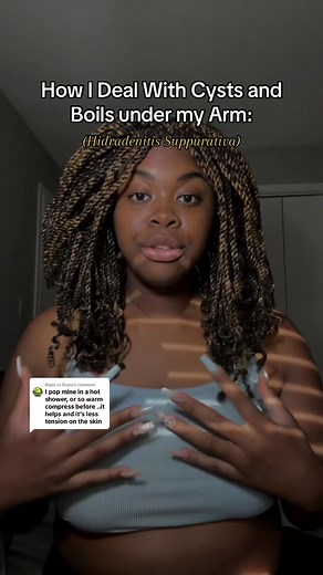 Replying to @Diana Having Hidradenitis Suppurativa, okay fine.... Maintaining it? GURL THATS A WHOLE OTHER BALL PARK. I cannot explain to you how many times I have just let it sit and ooze out because I was just too lazy to take care of it. I be over it at that point. If im being honest, I have those days a lot. But there are some days where I do cover it up and keep it clean to a T. It's just too much sometimes. #hidradenitissuppurativa #hs #hswarrior #boils #cysts #lumps