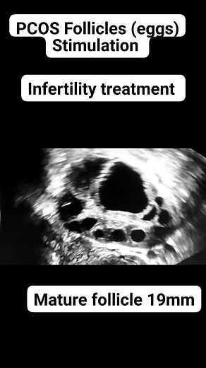 PCOS Follicles (eggs)stimulation #pcos #ultrasound #ultrasoundscan #pcostreatment | Dr.aneela manzoor-RPH