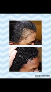 Medical Hair Transplant & Aesthetics on Instagram: "Black Woman with Hair Loss had her hair fully restored by Medical Hair Transplant & Aesthetics. We specialize in African curly hair transplant restoration surgery and also non surgical treatments. If you curly hair, look no further. Call us now at 408-356-8600 for best bald hair loss solution. Please call 1-408-356-8600 or email hairdr@mhtaclinic.com or visit our website at https://www.mhtaclinic.com or YouTube channel at https://www.youtube.co