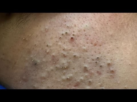 ASMR | BLACKHEAD REMOVAL | Deep Pore Cleansing and Facial Care Routine