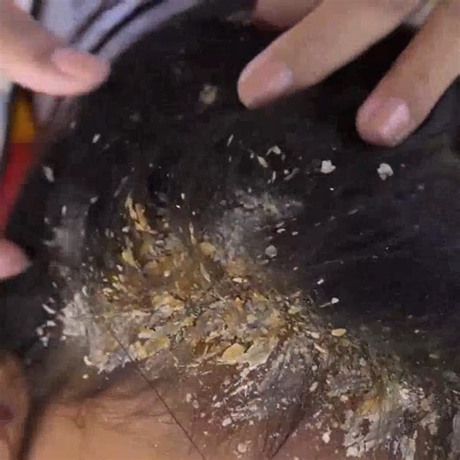 What the flake!! (Crazy dandruff) The Itchy scalp #47 #ticks #removetick #Dandruff #dandrufftreatment #dandruffremoval | Help remove ticks