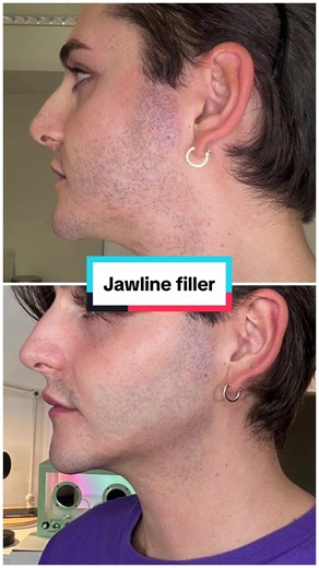 Trasformazione viso: prima e dopo il trattamento al botox bar