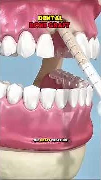 Dental Bone Graft Surgery Explained (3D Animation) 🦷