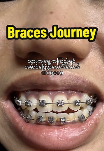 သွားနှုတ်တာကိုကြောက်လို့ ၂ ချောင်းစီ ၄ခါ ခွဲနှုတ်၊ ကြားထဲ ကြိုးလွတ်နေတာမသိလိုက်တော့ ကြိုးပြန်ဆင်းပြီး ၂ပတ်တစ်ခါ ကြိုးပြန်လဲပေးလိုက်ရတာကြောင့် process က ပိုကြာသွားတယ် 🥹 #braces #orthodontics #braceslife #smileupgrade #သွားညှိကုသခြင်း @cinnamodee-စင်နာမိုဒီး