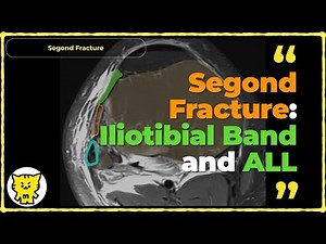 📌 Segond Fracture Explained: The Hidden Clue in ACL Tears!