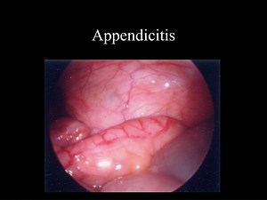 Appendicitis - SlideServe
