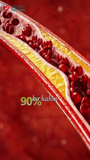 Angiography vs Angioplasty ❤️ What's the Difference? | Heart Doctor Explained