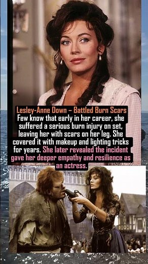 Lesley Anne Down – Battled Burn Scars #facts #new #hollywood #love #history