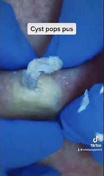 Cyst explosion pus