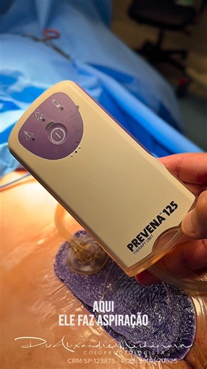 Dr. Alexandre Nishimura on Instagram: "Atualmente, dispomos de diversos recursos modernos para otimizar a cicatrização de feridas, tornando a recuperação mais rápida, segura e confortável. Um dos principais avanços é o curativo com pressão negativa, uma tecnologia que ajuda a reduzir edema, controlar secreções, melhorar a vascularização local e estimular a formação de tecido saudável, acelerando o processo de cicatrização. Pacientes com cisto sacrococcígeo (cisto pilonidal), por exemplo, frequen