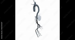 CTA whole aorta angiography filter view turn around the screen for diagnosis aortic aneurysm.