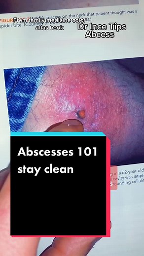 #abscess #treatment#incisionanddrainage #cellulitis #antibiotics #MRSA #strep #staph