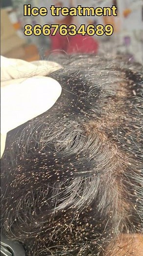 How to remove nits and lice #lice #nits #haircare #headliceremoval #peenu #eeru #haircare #covai