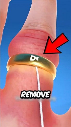 Ring Stuck on Your Finger? Try This Simple Trick! 💍 #Shorts #LifeHacks #SafetyTips