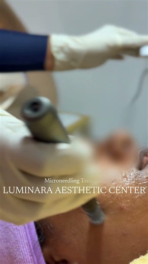 Microneedling