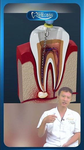 Root Canal Treatment Process | Dr. Yen