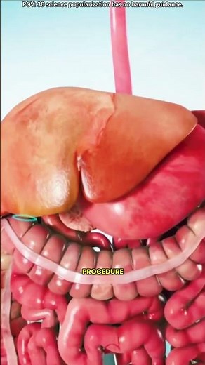 Gallbladder removal surgery 3D animation (cholecystectomy)