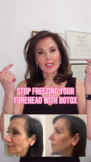 📣Stop freezing your forehead with Botox! I know I say it all the time, but there are other ways to get the lifting effect without eliminating all movement. #drdorisday #bestDAYever | Dr Doris Day
