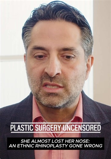 She almost lost her nose… and it started with what was supposed to be a “simple” revision. In this powerful episode of Plastic Surgery Uncensored, I sit down with my patient whose rhinoplasty journey took a terrifying turn—one that nearly ended in tissue loss and permanent damage. What began as a trusted relationship with a reputable Beverly Hills surgeon slowly unraveled after a revision procedure led to serious complications, infection concerns, hyperbaric treatments, and a desperate race to s
