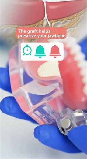 🦷 Recovering From a Tooth Extraction With a Bone Graft? Here’s What to Expect