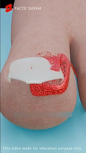 Truth About Ingrown Nails: Explained in 3D Animation #shorts #animation