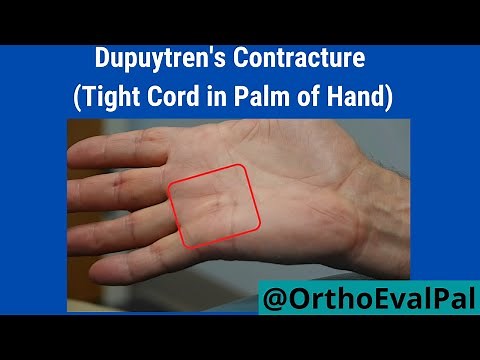 Dupuytren's Contracture (Tight Cord in Palm of Hand)
