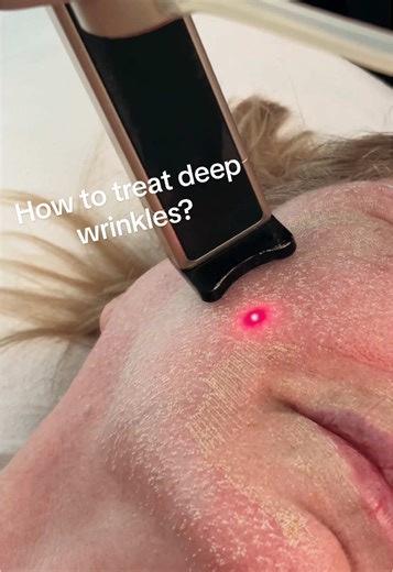 Effective Laser Treatment for Deep Wrinkles and Scars