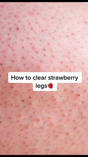 Smooth and Clear Legs: Strawberry Legs Treatment & Exfoliation Routine