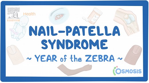 Nail-patella syndrome: Video & Causes | Osmosis