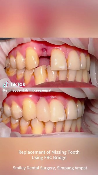 ✨ No implant? No problem. 💡 This is how we restore a missing front tooth with a fiber-reinforced bridge – fast, aesthetic & painless! 😁 . You can either walk in or book an appointment with us at 04-5265628 or you can directly WhatsApp : wasap.my/601117732988/dentaltreatment .